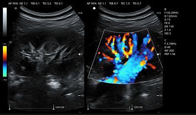 Kidney B &C mode.jpg Kidney B &C mode.jpg